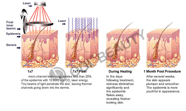Painless and effective removal of scars by laser Painless and effective removal of scars by laser