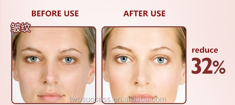 Eye Wrinkle Remover Machine .jpg