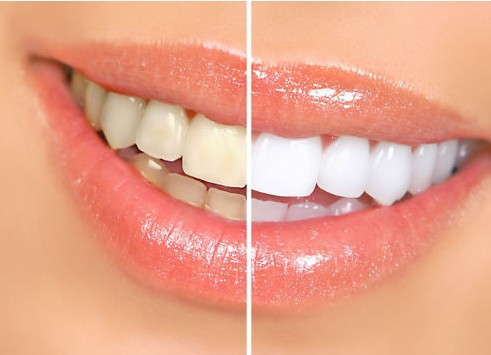 Biggest-promotion-10pcs-HIGH-STRENGTH-BLEACHING-TEETH-WHITENING-TOOTH-WHITENER-GEL-PEN-STRONG-WHITE