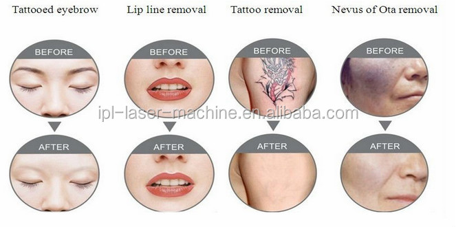 laser tattoo removal machine treatment result.jpg