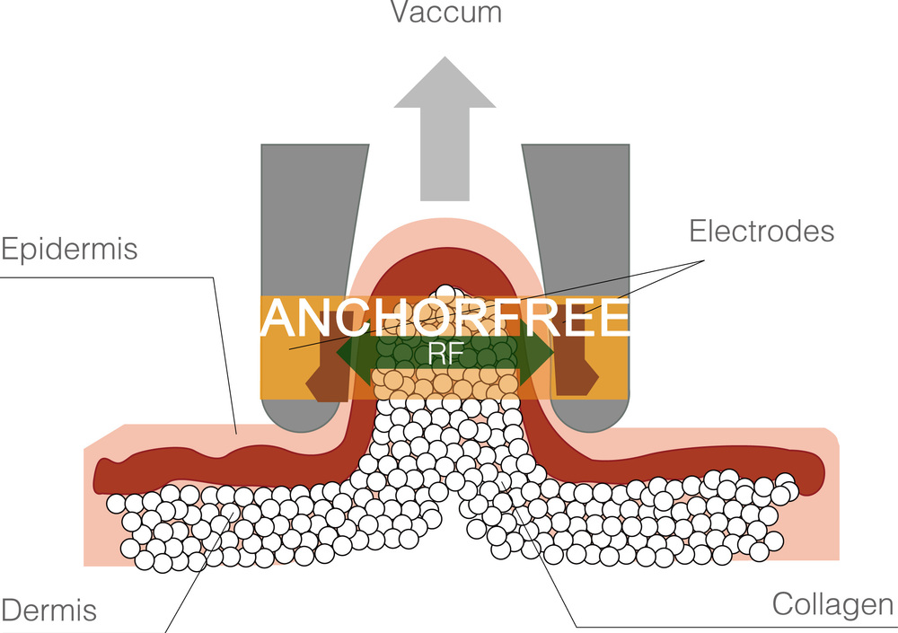 最高の減量anchorfree機( v8c1)問屋・仕入れ・卸・卸売り