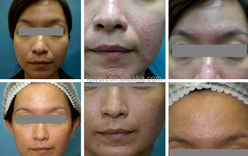 新しい到着のポータブルmicrodermabrasion2014年光子ledを搭載したマシン問屋・仕入れ・卸・卸売り