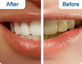 OEM supplier Instant Smile teeth whitening foam,best teeth whitening toothpaste