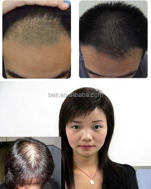 信頼できる中国サプライヤーce承認2015髪厚いとスムーズ抗脱毛ダイオードレーザー髪の成長のための問屋・仕入れ・卸・卸売り