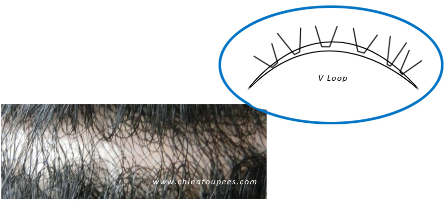 Derma roller for hair loss treatment,hair loss treatment for black men,hair loss treatment-v loop.jpg
