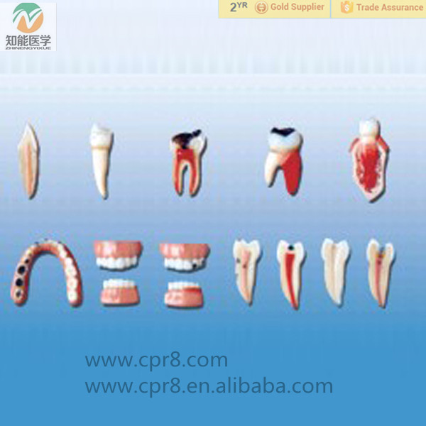 common oral diseases model/pulpitis,periodontitis,decayed tooth