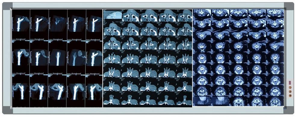 medical led view lamp xray film negatoscope x ray view box for