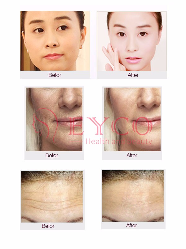 F-B08 RF beauty device-2 (1)