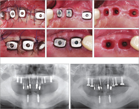 インプラント審美dentis輪郭プロテーゼ仕入れ・メーカー・工場