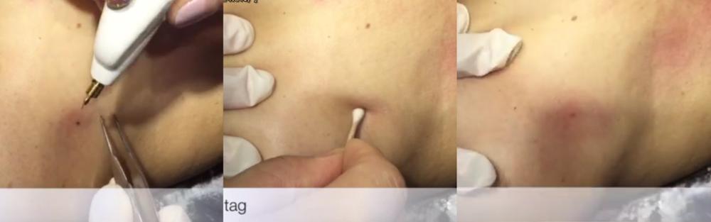 slova papillom shmel dlya udaleniya apparat schitayu Аппарат для удаления папиллом шмель фото